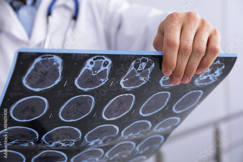 Doctor examining MRI images of patient with multiple sclerosis in clinic, closeup photo