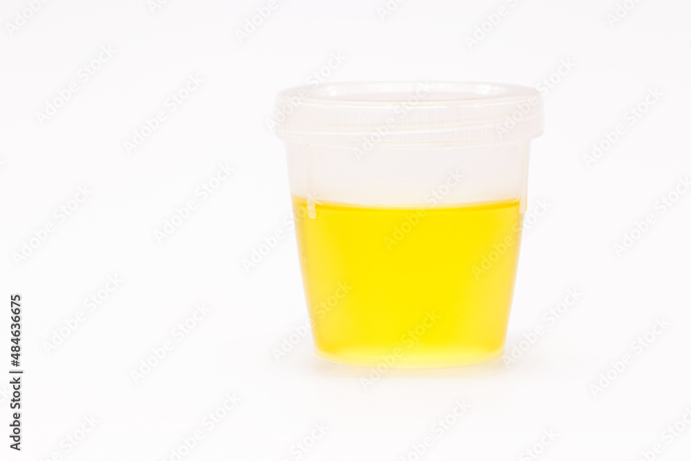 collection bottle with urine, urinalysis EAS Abnormal Sediment