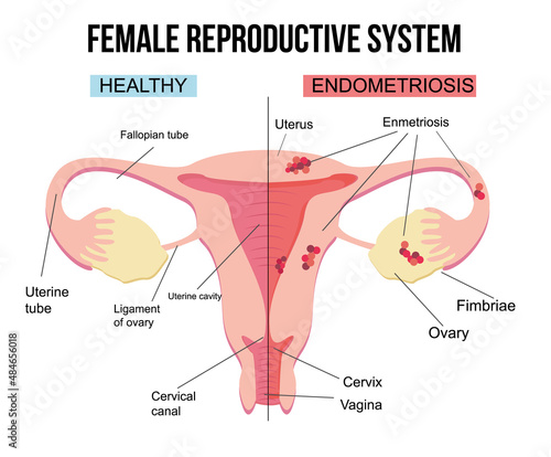 Female reproductive system, endometriosis.Scheme of gynecological diseases of the uterus.The state of growth of external tissues within the female body. Structure with painful sick and healthy example