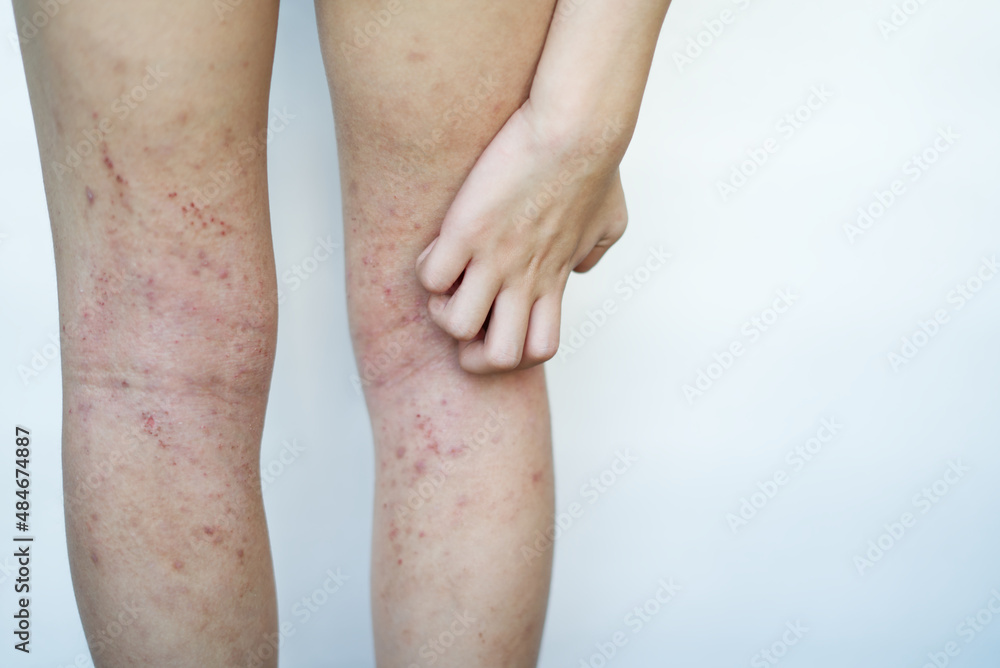 Allergy skin of an Asian kid on her legs with hand to scratch in natural light. Allergy skin of an Asian kid on her legs with hand to scratch in natural light.
