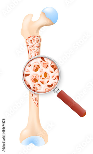 density of a healthy bone. Cross section of human femur. 