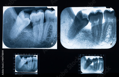 Detailed X-ray scan with impacted wisdom teeth issue photo