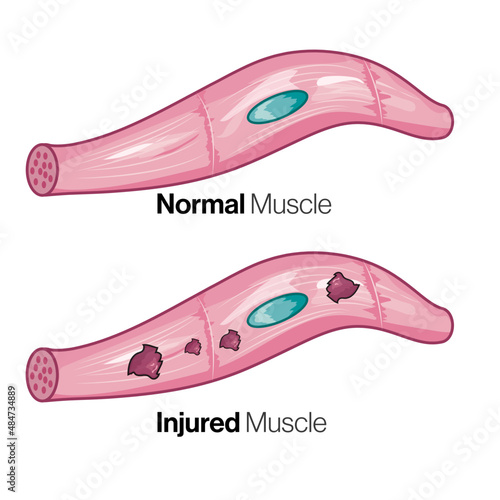 Normal and Injured Muscle Anatomy, Detailed Vector Illustration of Healthy and Damaged Muscular Tissue, Medical Education and Rehabilitation Concept on White Background.
