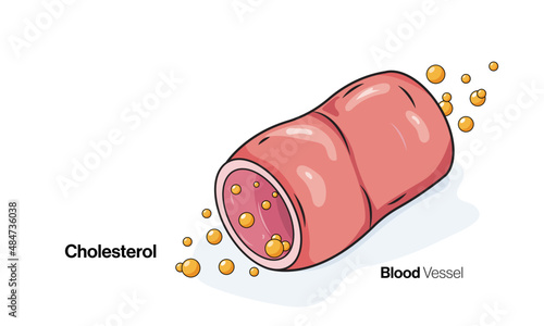 cholesterol in blood vessel illustration.