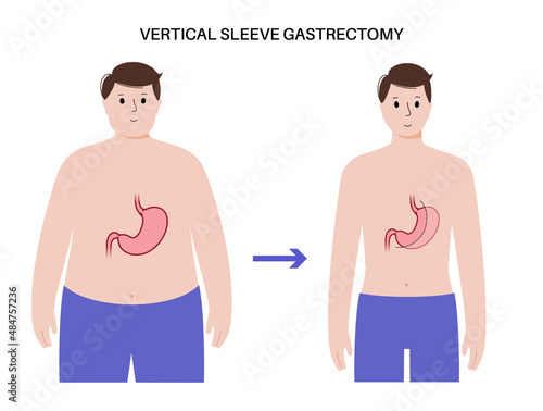 Laparoscopic sleeve gastrectomy