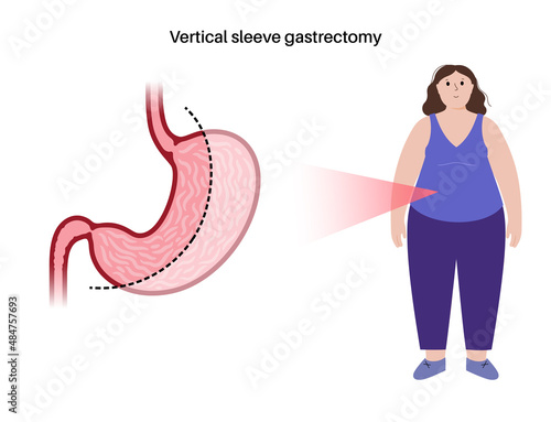 Laparoscopic sleeve gastrectomy