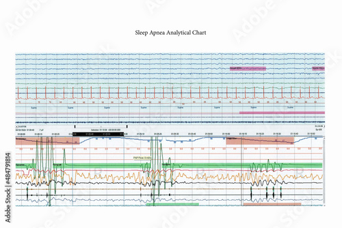 obstructive sleep apnea symptom chart from sleep test for doctor to analytics of breathing problem at sleep