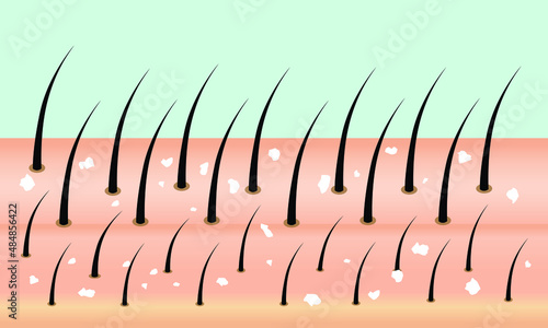 Dandruff in the dark hair, closeup view. Scalp having dandruff vector.