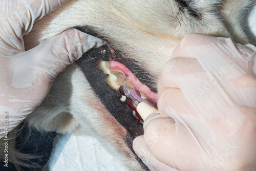 The process of cleaning calculus (dental tartar) using ultrasonic scaler.