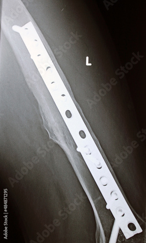 Plain X ray on the left femur that shows united mid shaft left femur fracture after open reduction orthopedic surgery with internal fixation with broad metallic Dynamic Compression Plate and screws photo