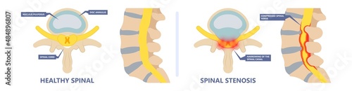 Spinal stenosis a narrowing of the spaces of the spine that causes lower back pain annulus nucleus bulged older cord muscle weakness neck cauda equina injury cushioning vertebrae disk bone	 photo