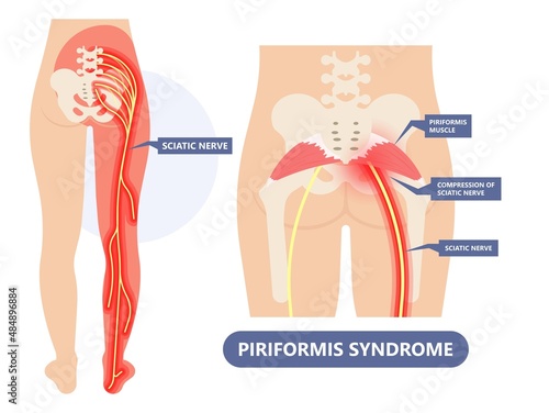 Piriformis syndrome pain and numbness in buttocks and down the back of leg photo