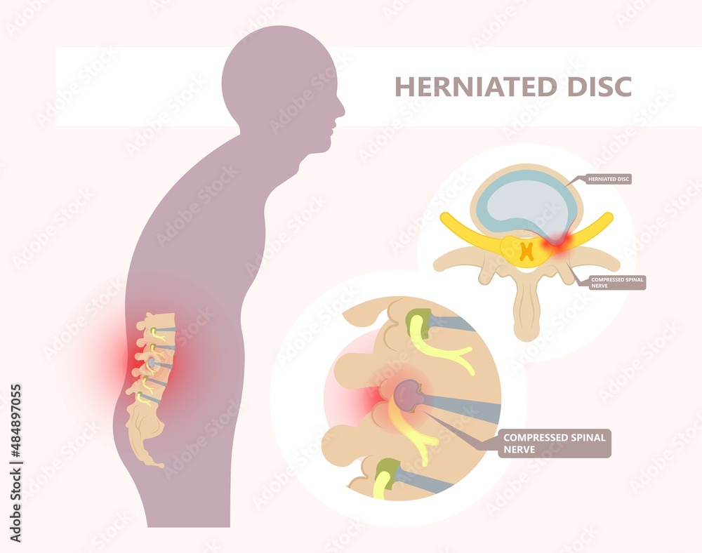 Herniated disc injury to the cushioning and connective tissue between