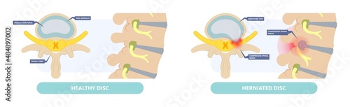 Herniated disc injury to the cushioning and connective tissue between vertebrae disk bone back annulus nucleus bulged older cord muscle weakness neck cauda equina photo