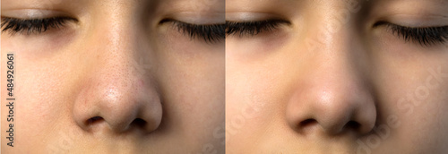 Close-up blackhead acne blames on boy's nose. Compare before and after treatments, skin care problem in teenager. photo