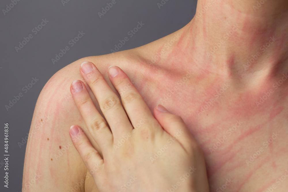 Closeup of a young woman’s skin with dermatographia.
