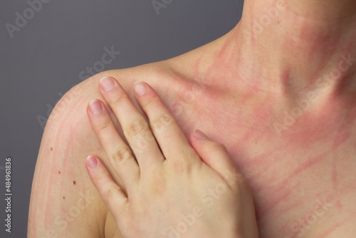 Obraz na płótnie Closeup of a young woman’s skin with dermatographia. w salonie