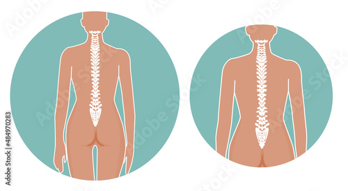 Spinal correct posture