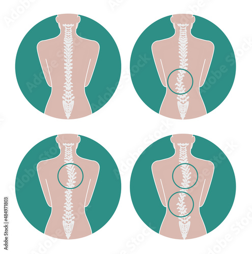 Spinal scoliosis types photo