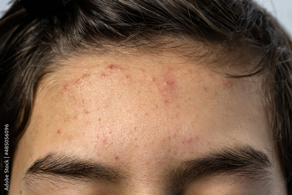 Close up Acne and blackhead pimples skin rash on teenage boy's forehead. Face skin problem concept. Close up Acne and blackhead pimples skin rash on teenage boy's forehead. Face skin problem concept.