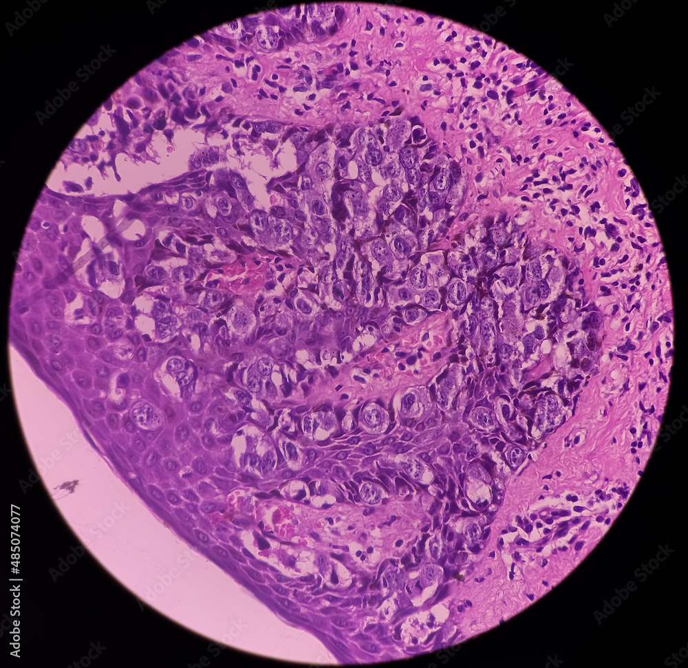 Nipple ulcer biopsy Paget's disease of the nipple, microscopic image
