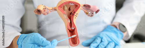 Gynecologist holds urogenital cytobrushes and model of female reproductive system photo