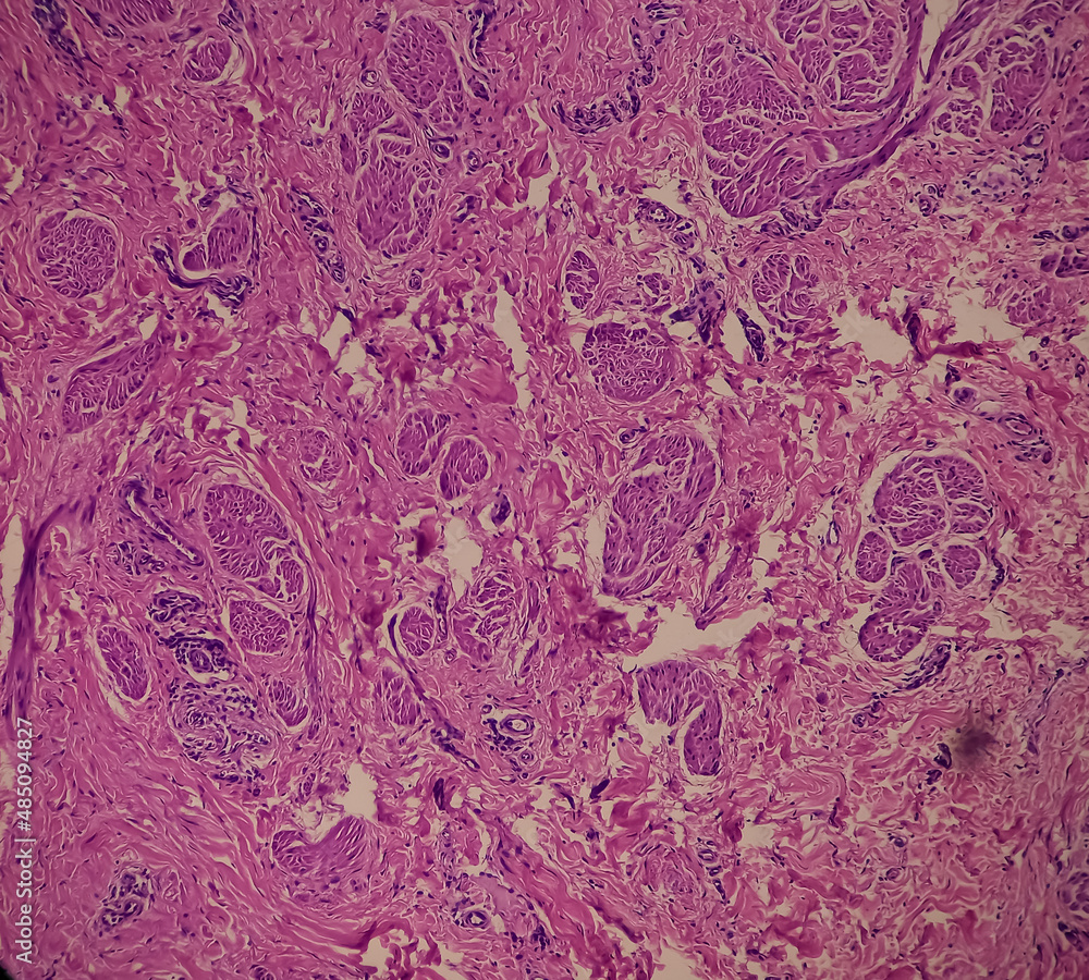 Nipple ulcer biopsy Paget's disease of the nipple, microscopic image