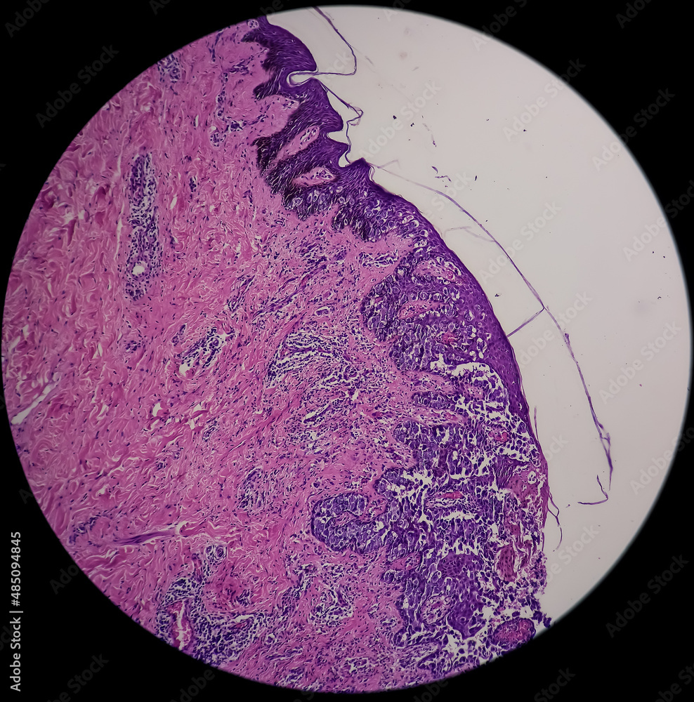 Nipple ulcer biopsy Paget's disease of the nipple, microscopic image