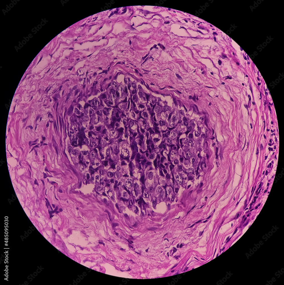 Nipple ulcer biopsy Paget's disease of the nipple, microscopic image