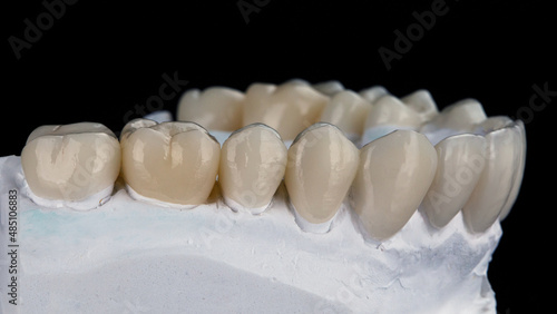 a set of ceramic crowns with masticatory anatomy on a plaster model, photo on a black background photo