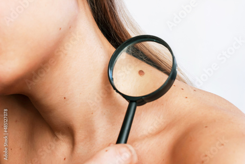 Close-up of a big mole on a young woman's neck magnified with a magnifying glass isolated on a gray background. The effect of sunlight on the skin