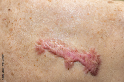 Patient with Spontaneous keloid scar