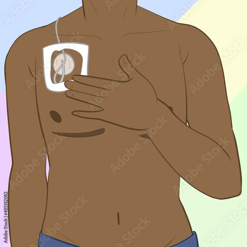 Chest IV Port