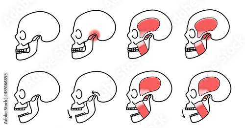 Illustration of lateral view of human skull, normal skull, mouth opening, red highlight on TMJ, muscle of mastication, Dental icon for Occlusion.