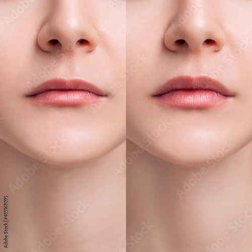 Female lips before anf after augmentation procedure.