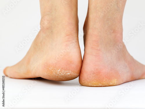 Dry skin, plantar callosity and flakes on the female heel and feet sole close up on white background. Image for medical purposes. photo