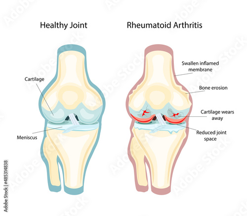 Rheumatoid Arthritis RA that usually affects knees. the auto immune disease. Vector Illustration