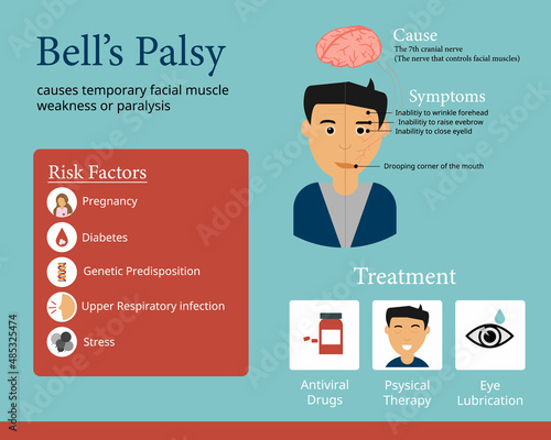 Bell’s palsy infographic to show the cause the symptom of it