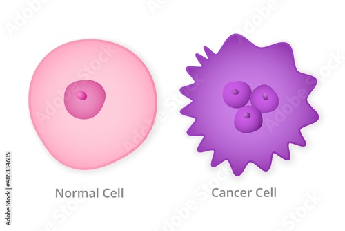 Normal and cancer cell. Healthy pink natural form and metastasized purple with numerous carcinomas oncological growths and tumor vector divisions.