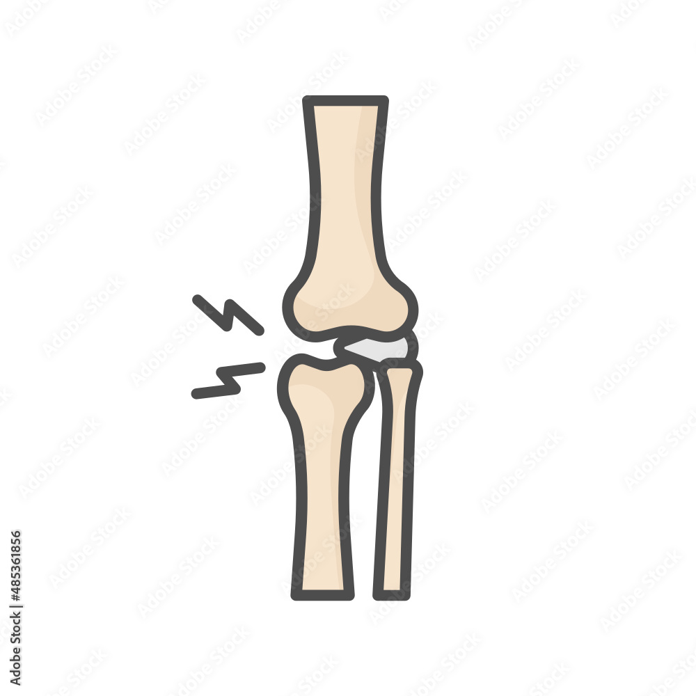knee arthrosis knee arthrosis
