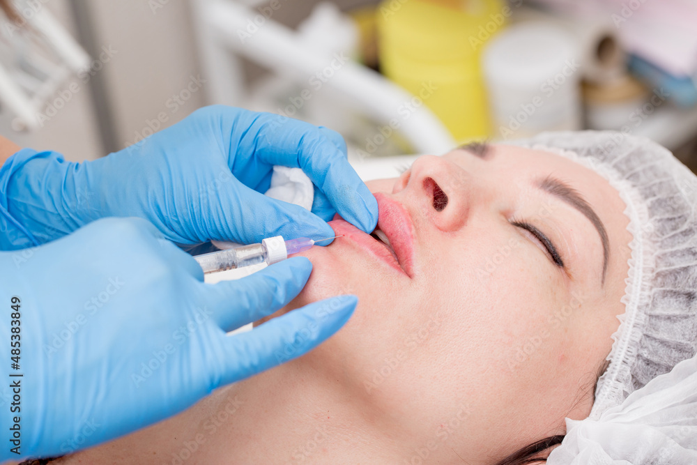 Lip augmentation. Beautician injects hyaluronic acid into the lips of a girl with a syringe. The cosmetologist doctor performs the procedure in the cosmetology office. Plastic surgery. Lip augmentation. Beautician injects hyaluronic acid into the lips of a girl with a syringe. The cosmetologist doctor performs the procedure in the cosmetology office. Plastic surgery.