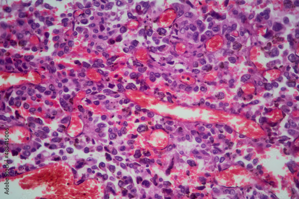 Lung tissue adenocarcinoma with HE stain as seen under a microscope.