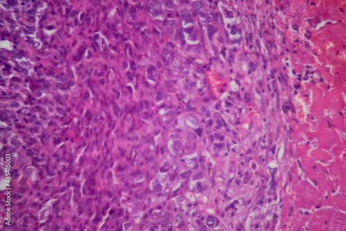 Lung tissue adenocarcinoma with HE stain as seen under a microscope.