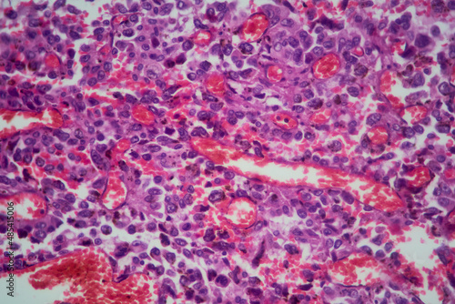 Obraz na płótnie Lung tissue adenocarcinoma with HE stain as seen under a microscope. w salonie