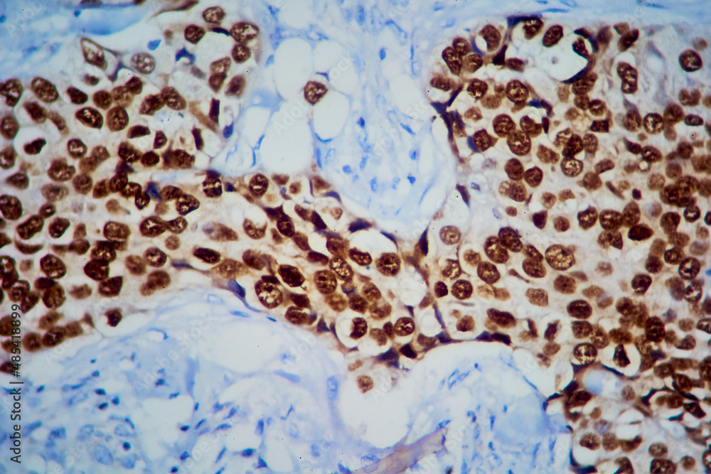 Breast tissue adenocarcinoma immunohistochemistry. Estrogen receptors.