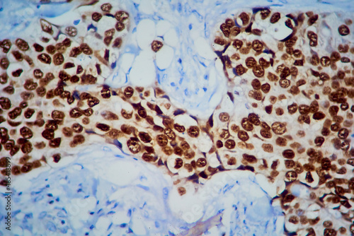 Obraz na płótnie Breast tissue adenocarcinoma immunohistochemistry. Estrogen receptors. w salonie