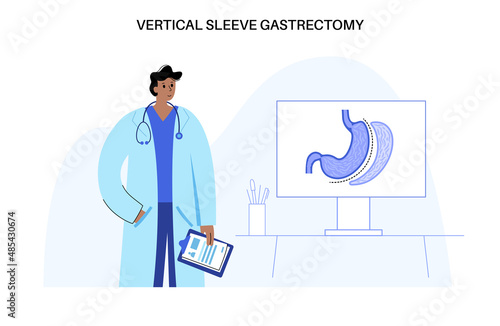 Laparoscopic sleeve gastrectomy photo