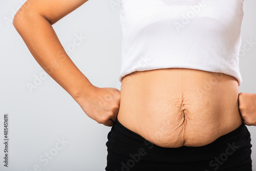 Close up of Asian mother woman showing stretch mark loose lower abdomen skin she fat after pregnancy baby birth, studio isolated on white background, Healthy belly overweight excess body concept
