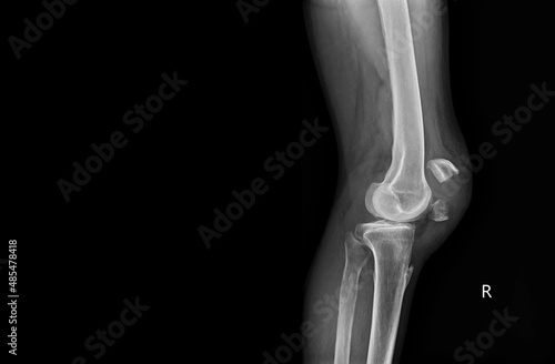 A film x-ray of left knee lateral view shown fracture of knee cap(patella) bone. The plain film on dark background with copy space.Medical concept. photo