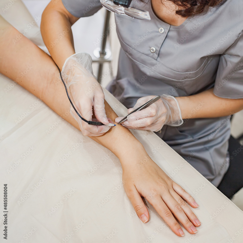A female cosmetologist performs the procedure of permanent removal of unwanted hair in the forearm by electroepilation device and tweezers